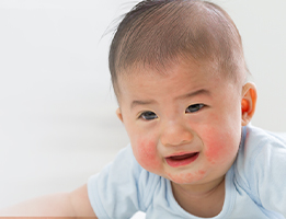 Alergi pada Bayi